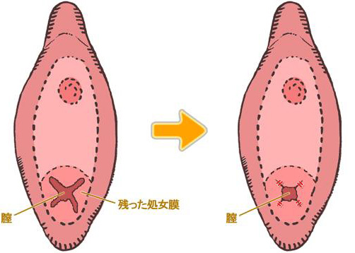処女膜再生