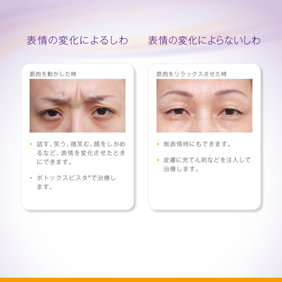 しわの種類