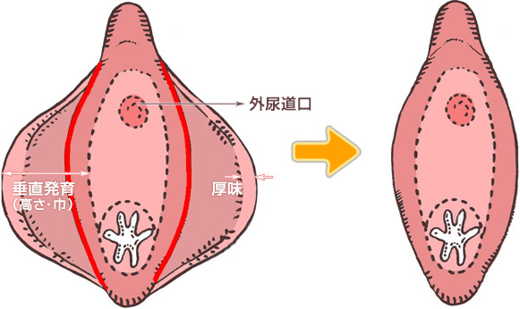 小陰唇縮小