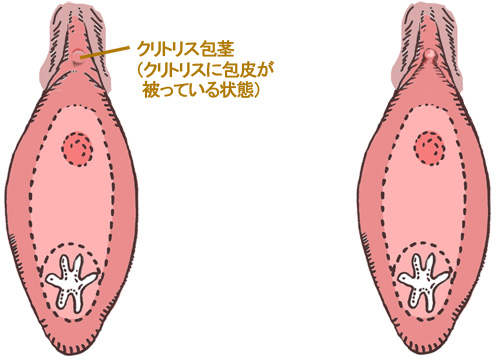 クリトリス包茎