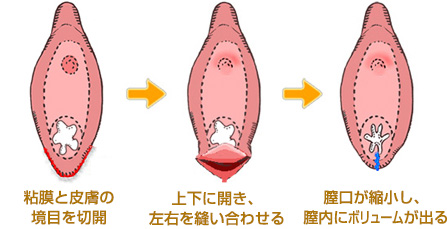 膣縮小