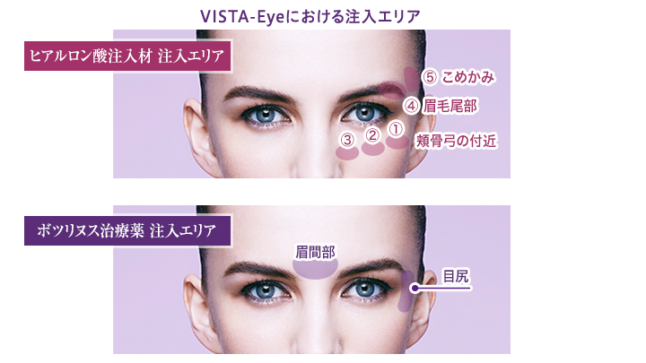 ビスタアイ注入エリア