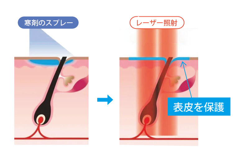 照射イメージ